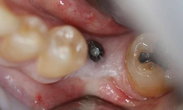 Gum-Graft-around-Implant-Before-Image