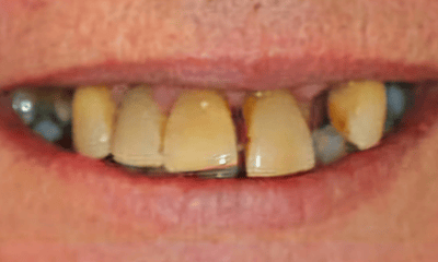 Before treatment - Implant-Retained Denture