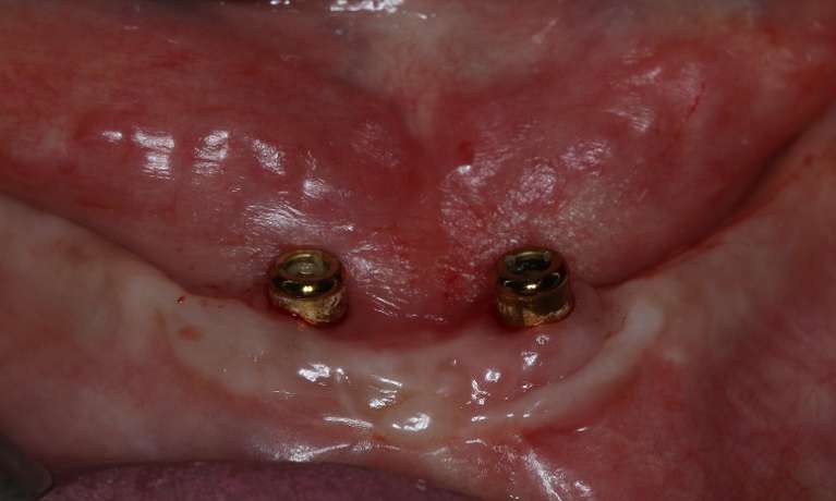 implant-retained dentures east hills