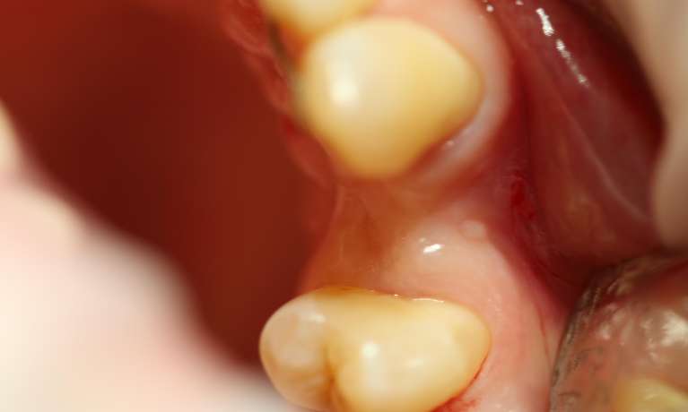 dental implants east hills | before