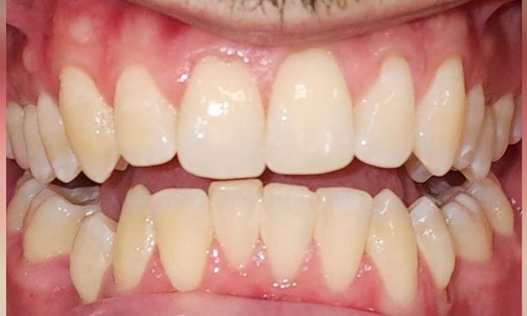Invisalign-Transformation-Before-Image
