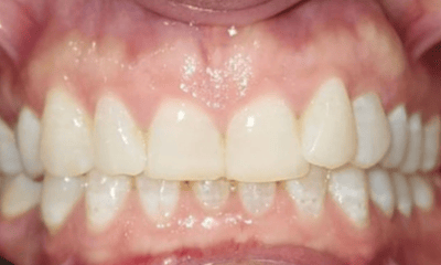 Before treatment - Invisalign Treatment