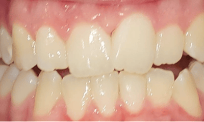 Before treatment - Invisalign Treatment