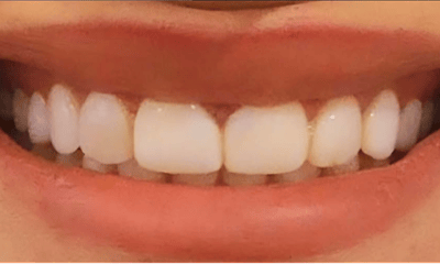 Before treatment - Invisalign Treatment