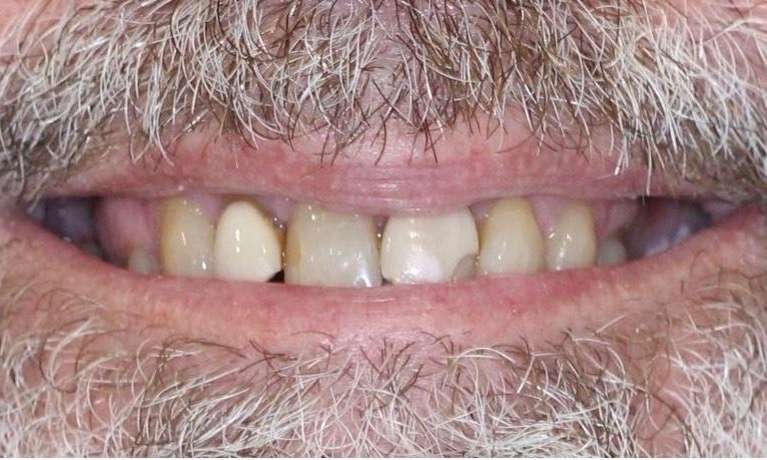 composite bonding before | cosmetic dentist east hills