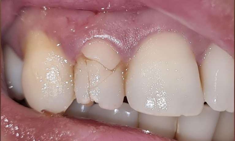 Tooth-Trauma-Fixed-With-Dental-Implant-Before-Image