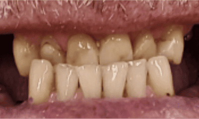 underbite before all on 4 in East Hills, NSW