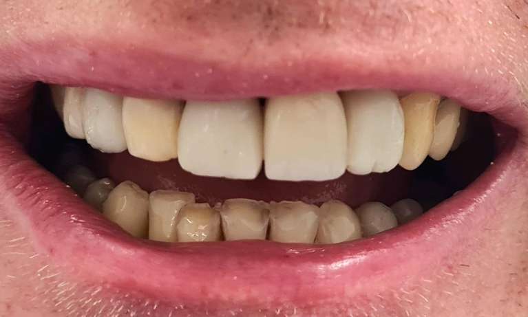 dental veneers east hills | before