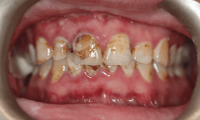 dental veneers east hills | before veneers