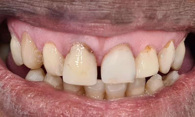 dental veneers east hills | before