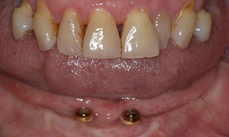 implant-retained dentures east hills | before dentures