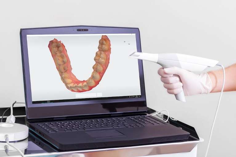 Dentist East Hills | Digital Impressions
